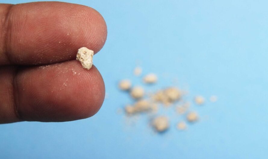 Kidney Stones: Symptoms, Causes, Treatment, Types & Prevention
