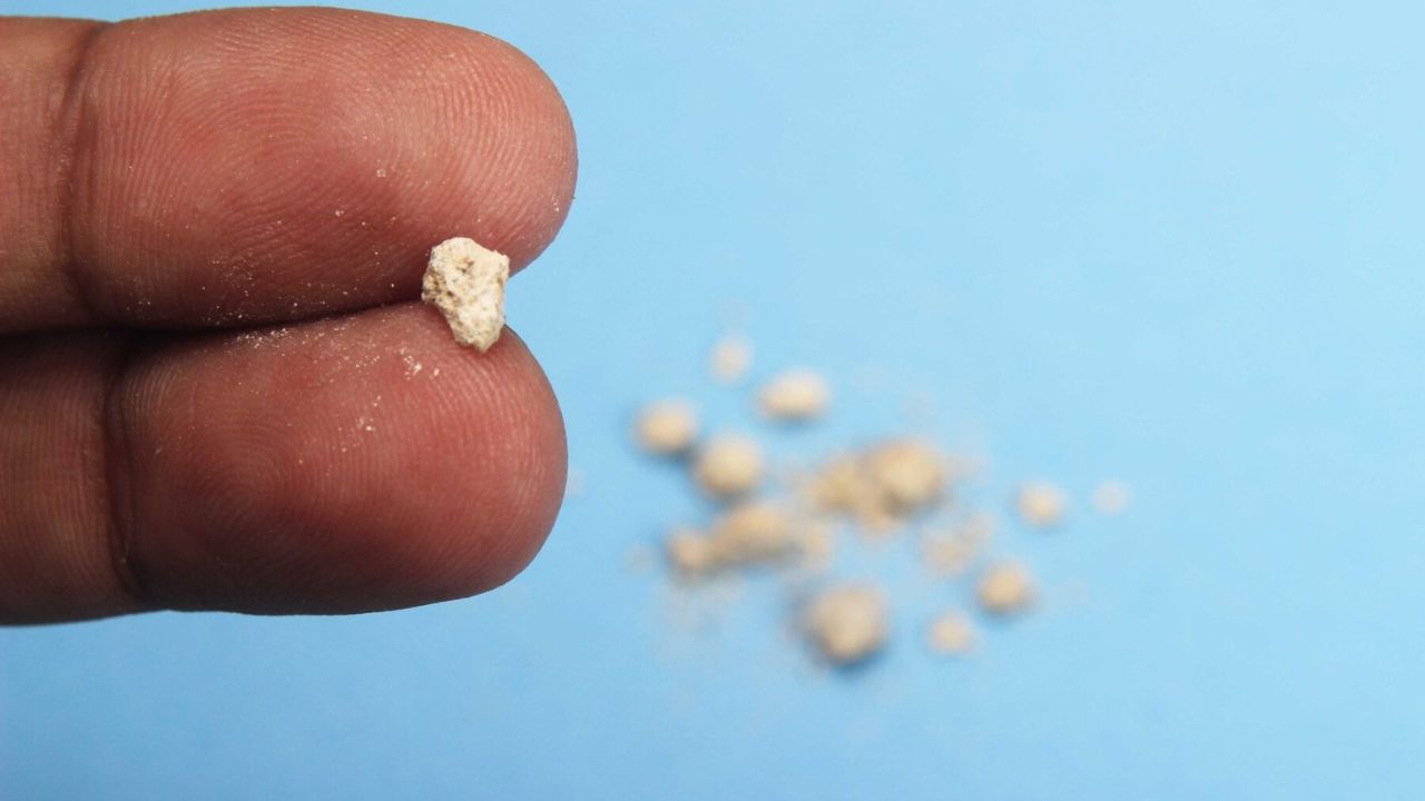 Kidney Stone