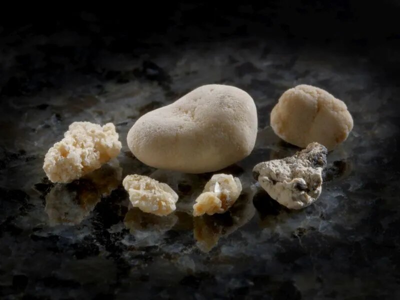 Kidney Stone